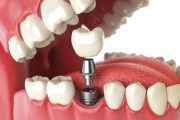 dental implants London